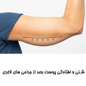 شلی و افتادگی پوست بعد از جراحی های لاغری