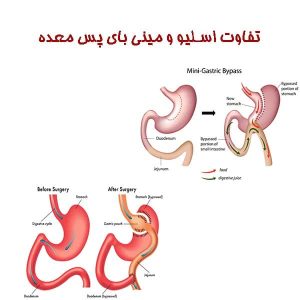 تفاوت اسلیو و مینی بای پس معده