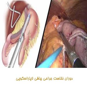 دوران نقاهت جراحی چاقی لاپاراسکوپی