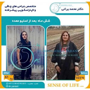 اسلیو معده 41