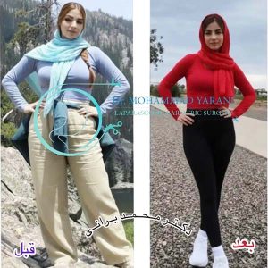 اسلیو معده 44