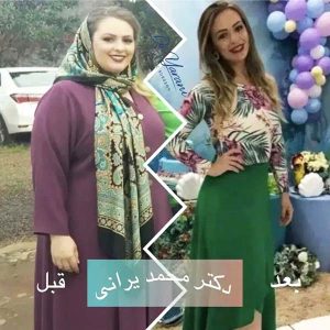 اسلیو معده 45
