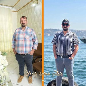 اسلیو معده 51