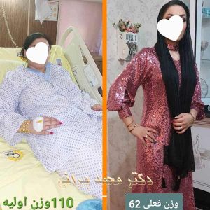 اسلیو معده 57