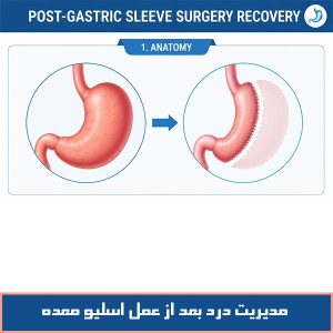 مدیریت درد بعد از عمل اسلیو معده