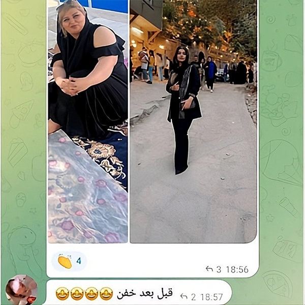 نظر بیمار درباره نتیجه عمل اسلیو معده با دکتر محمد یرانی