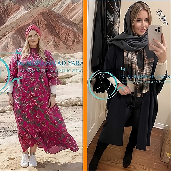 نمونه نتیجه عمل اسلیو معده