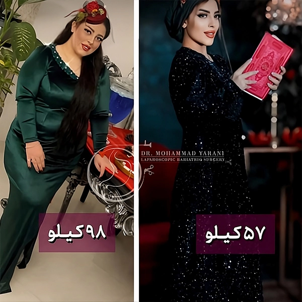 کاهش وزن بیمار پس از عمل اسلیو معده