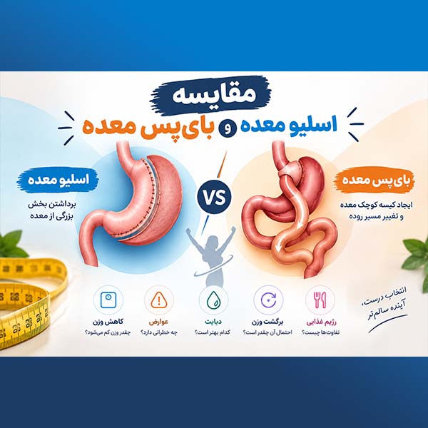 مقایسه اسلیو معده و بای‌پس معده